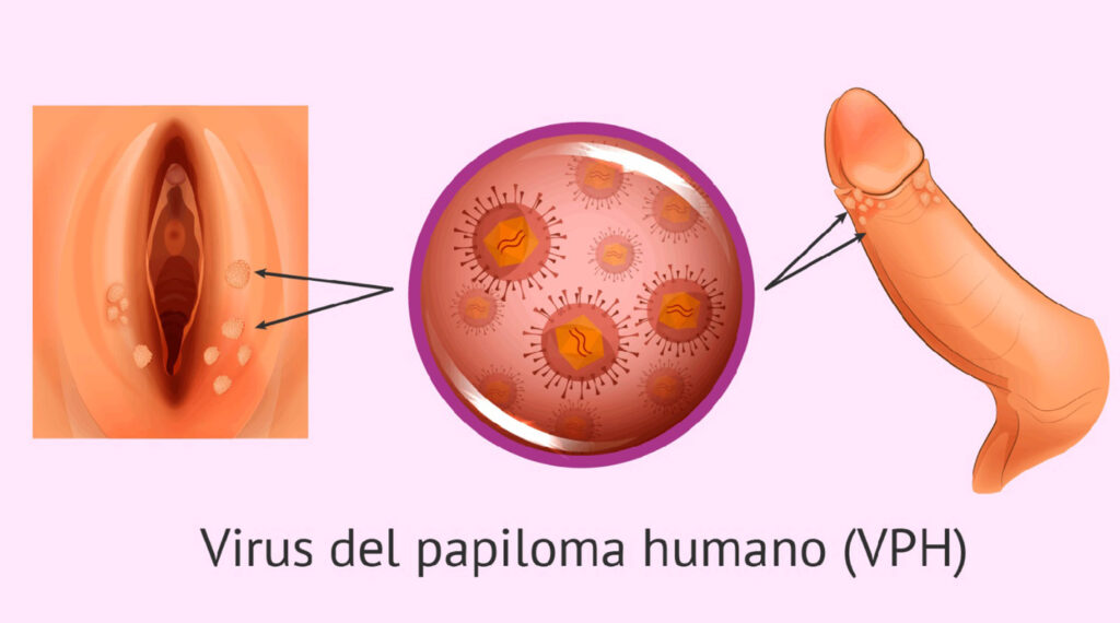 Identifican proceso por el que el VPH produce cáncer