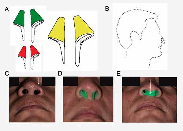 Mejoran simetría nasal en pacientes con paladar hendido