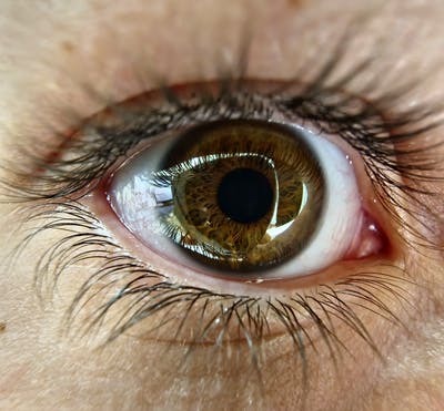Degeneración macular una de las causas de ceguera 