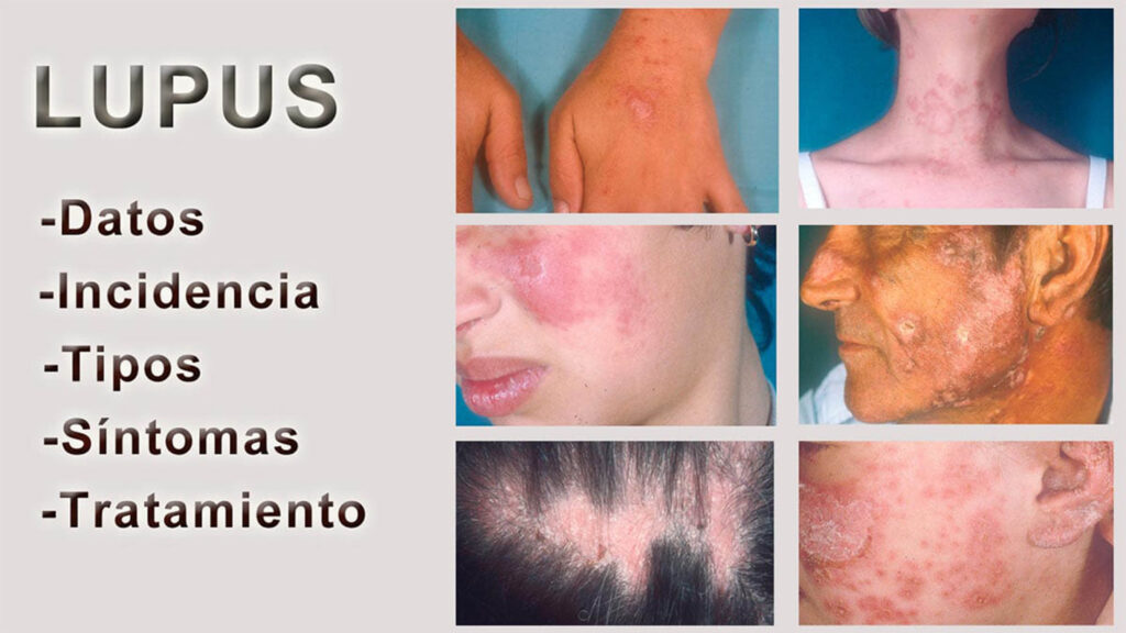Avanza Registro Mexicano de Lupus elaborado por UNAM