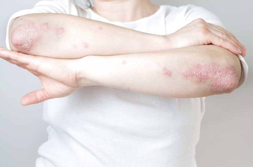 Psoriasis Pustular Generalizada: enfermedad  mortal