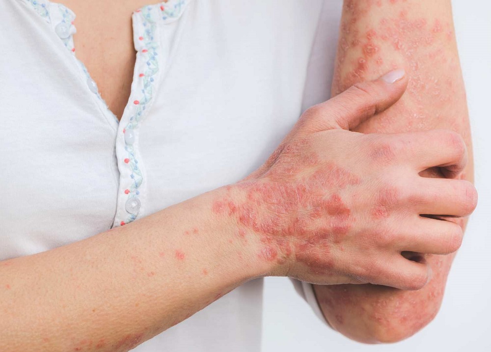 Psoriasis Pustular Generalizada: enfermedad  mortal