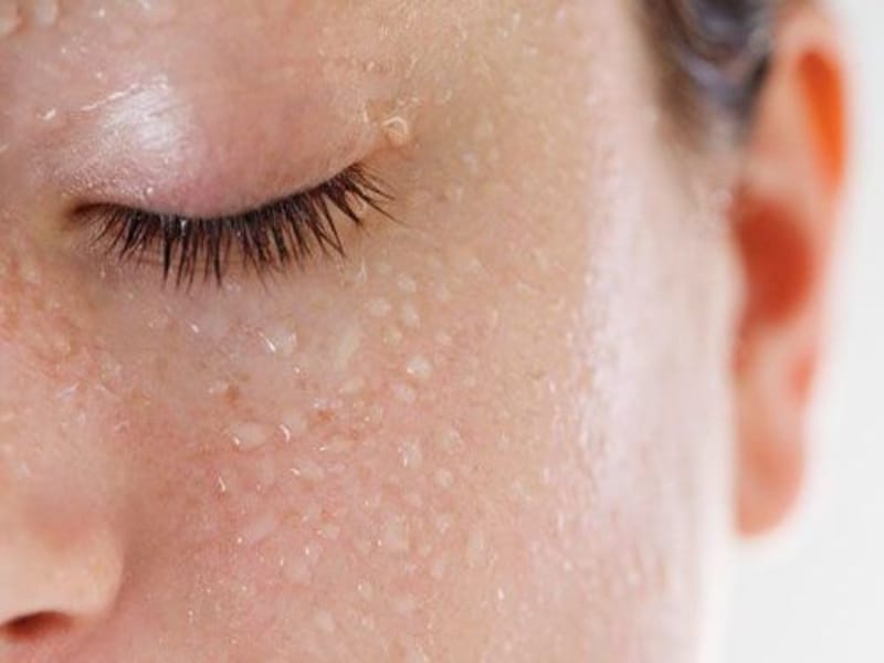 Cómo tratar la sudoración excesiva de la cara