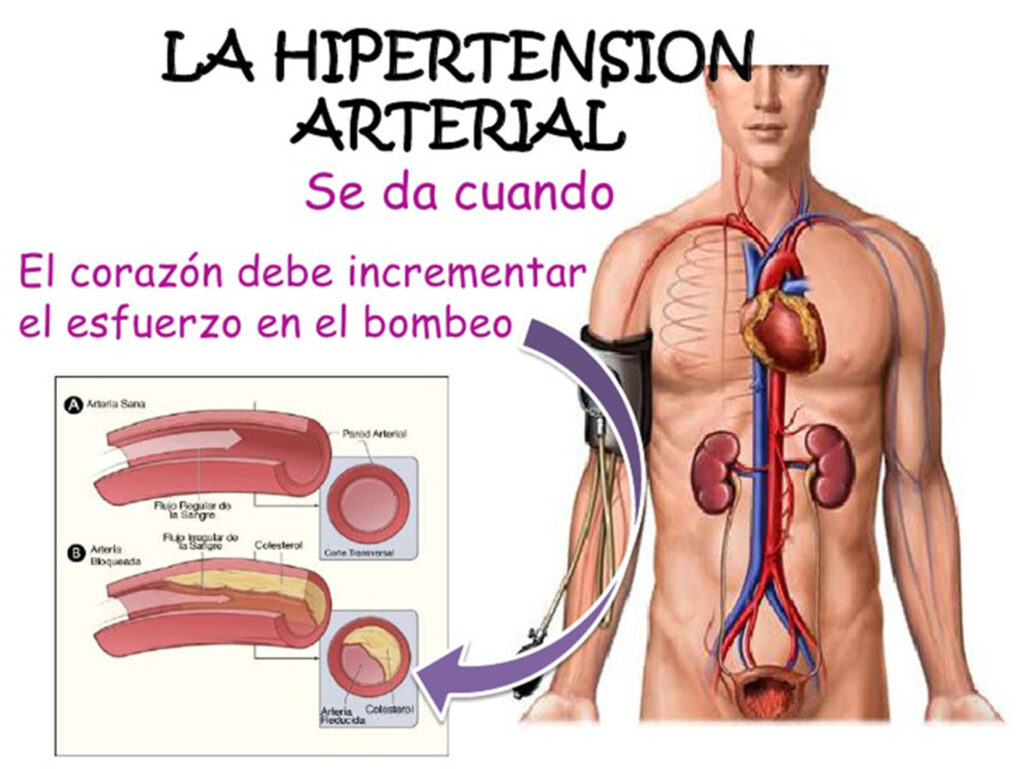 Ausencia de síntomas de hipertensión no es estar sano