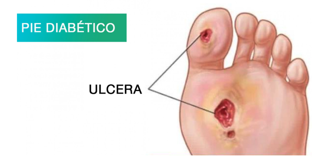 Úlceras de pie diabético demandan atención médica