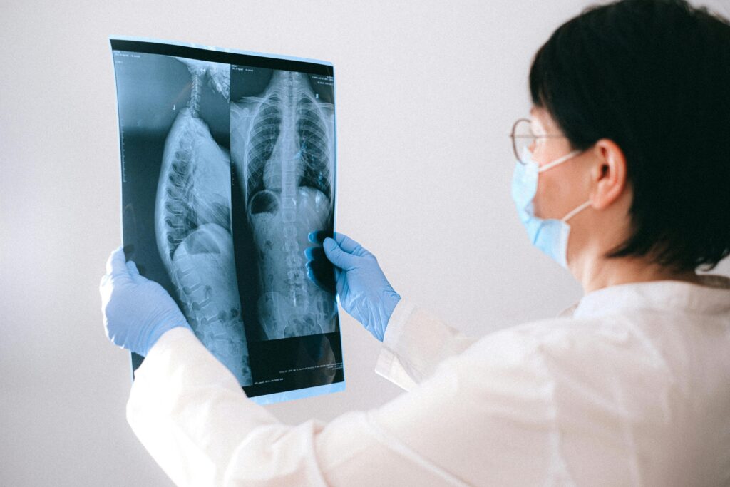 Molécula de frena deterioro en Fibrosis Pulmonar